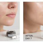 How to Get Clear Skin in a Week transformation journey
